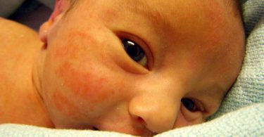 5 Safe and Effective Ways to Treat Pimples in Babies